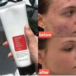 شوينده ساليسيليك اسيد كوزاركس ضد جوش - تصویر 3